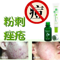 去除后背部封闭合性痤疮痘痘全清霜祛胸前豆豆油性粉刺平乳膏