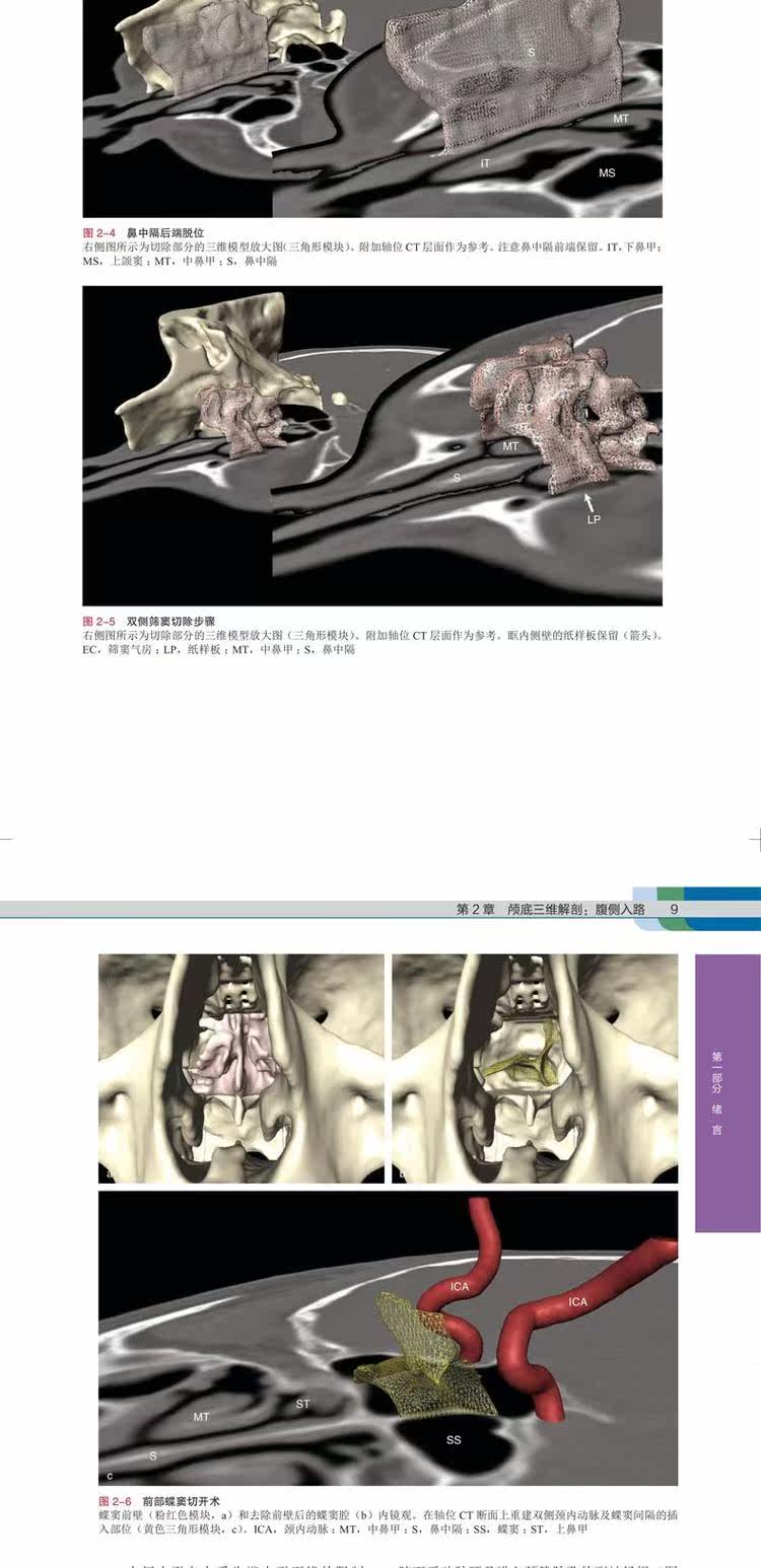 正版现货 鼻窦及颅底内镜手术入路分步解剖操作指南中文翻译版曼努埃尔贝纳尔斯普雷克尔森等鼻窦外科及颅底外科内镜手术书籍