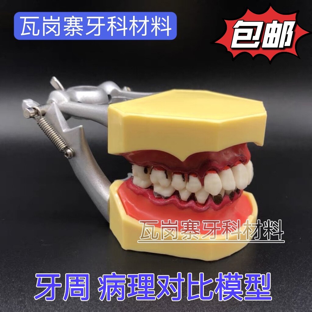 牙科口腔模型牙结石牙周分类牙周对比模型龈上龈下刮治牙结石模型