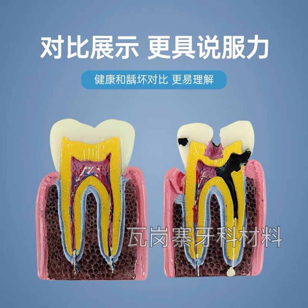 牙科口腔模型  解剖放大蛀牙模具医患沟通六倍牙齿龋坏病理演示