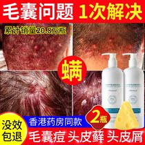 Scalp folliculitis special medicine Zekang lotion Scalp ringworm ointment Head dandruff Coal tar Psoriasis ringworm shampoo