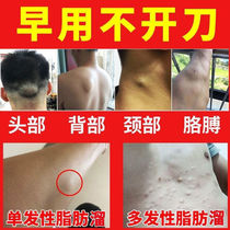 Fat removal artifact Whole body subcutaneous fat retention paste Multiple anti-tumor cream Eliminate lumps buster