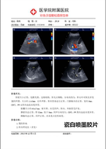 Porcelain white inkjet laser dual-use film paper double-sided inkjet printing B-ultrasound four-dimensional color ultrasound gastroenteroscope 0 18mm
