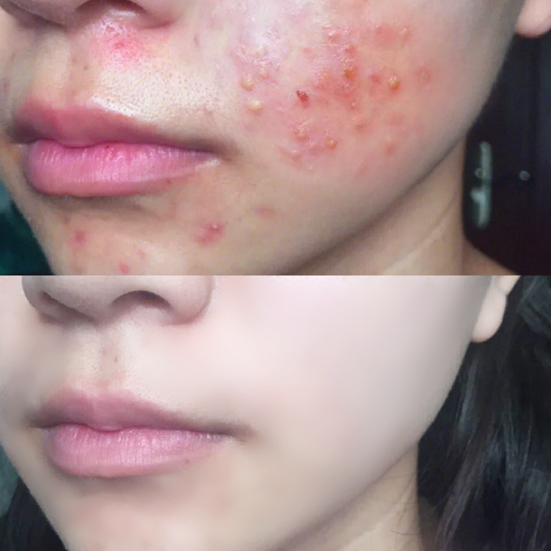 In addition to mites soap Li Jiaqi recommends washing face soap to go to the mite to acne face to remove the mite from the face cleaning and removing the mite