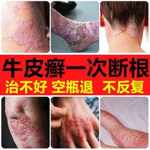 Special treatment for psoriasis hand foot and femoral moss psoriasis ointment