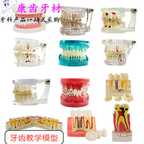 Dental dental model Dental implant mold Pathological restorative dental model Dental standard Doctor-patient communication teaching