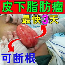Fatty neoplasmosis remover Digestive Tumor Cream Paste With Multiple Fat Subcutaneous Elimination Of Hard Lump Total Systemic Pink Neoplasm
