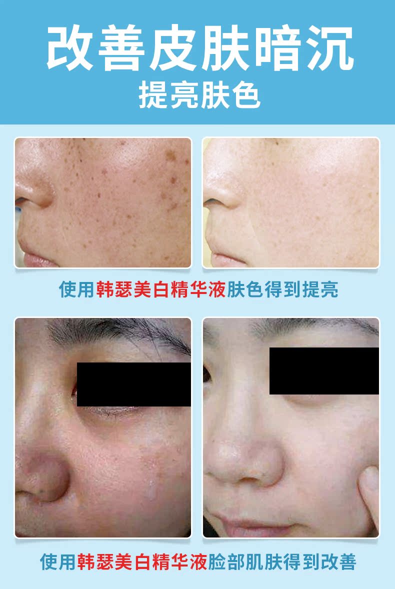 Tinh chất làm trắng da mặt Hanse Thu nhỏ lỗ chân lông làm sáng da tinh chất bơ skinaz
