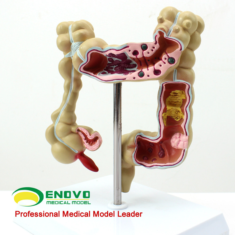 Medical Human Anatomy ENOVO NAUANO HUMAN COLON LESION MODEL ANORECTAL DIGESTIVE ENDOCOLOGY LARGE INTESTINE