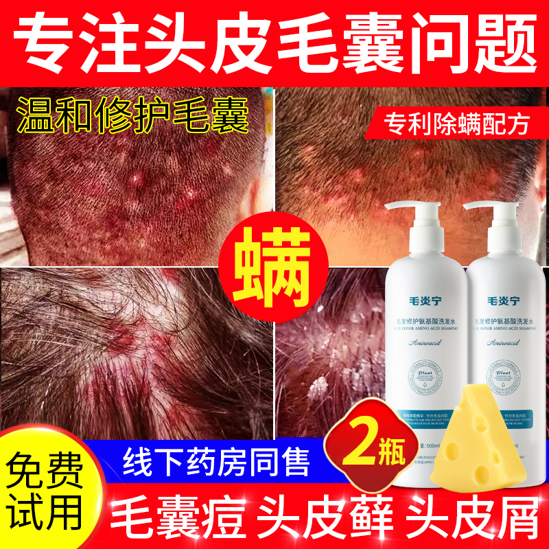 Scalp hair follicles de-mite dandruff dandruff amino acid shampoo dew remove mite anti-dandruff anti-itch control oil cleaning artifact