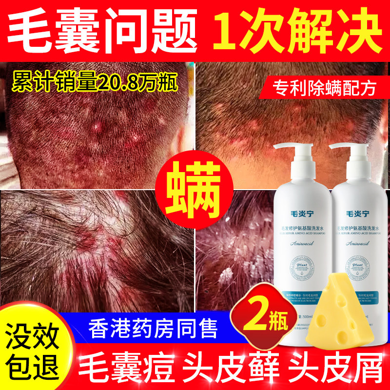 Scalp hair follicle anti-mite dandruff inflammation Amino acid shampoo dew mite anti-dandruff anti-itching oil control cleaning artifact