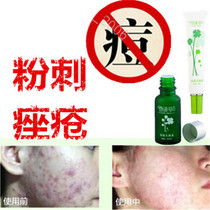 Remove mens and womens oily acne flat acne back closed acne oil granule medicinal essence cream
