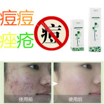 Remove facial rosacea for men and women repair closed acne acne remove acne on chest back and forehead