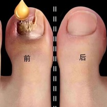 Tong Ren Tang hot sale (refundable if damaged) Just drop by drop bad nails will turn into good ones new nails will grow and you can enjoy a life of good nails.