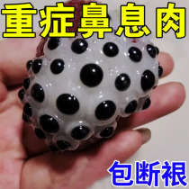 Nasal polyps (will fall off automatically without surgery) sinusitis nasal congestion turbinate hypertrophy clearing nasal polyps rhinitis and blockage