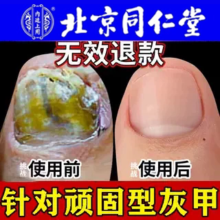 Specialized Anti-Fungal Nail Treatment Solution from Nanjing Tong Ren Tang, Official Flagship Store No. 1 in Japan, One-Drop Antibacterial Liquid Specialized Anti-Fungal Nail Treatment Solution from Nanjing Tong Ren Tang, Official Flagship Store No. 1 in Japan, One-Drop Antibacterial Liquid