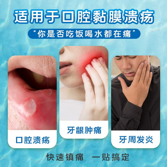 10片装】意可贴醋酸地塞米松口腔溃疡贴片非感染性口腔黏膜溃疡