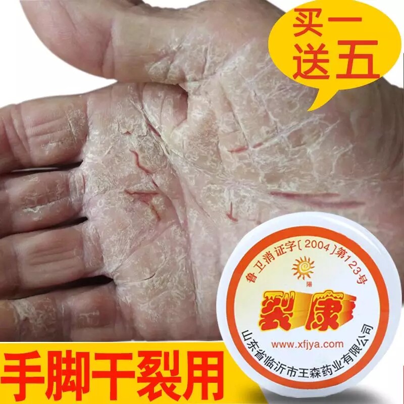 Cracked mouth oil Cracked Cream Cracking Dry Cleft Patron Cream Feet Dry Cracked Tortoise Crack Repair Depippable Total Season Conn