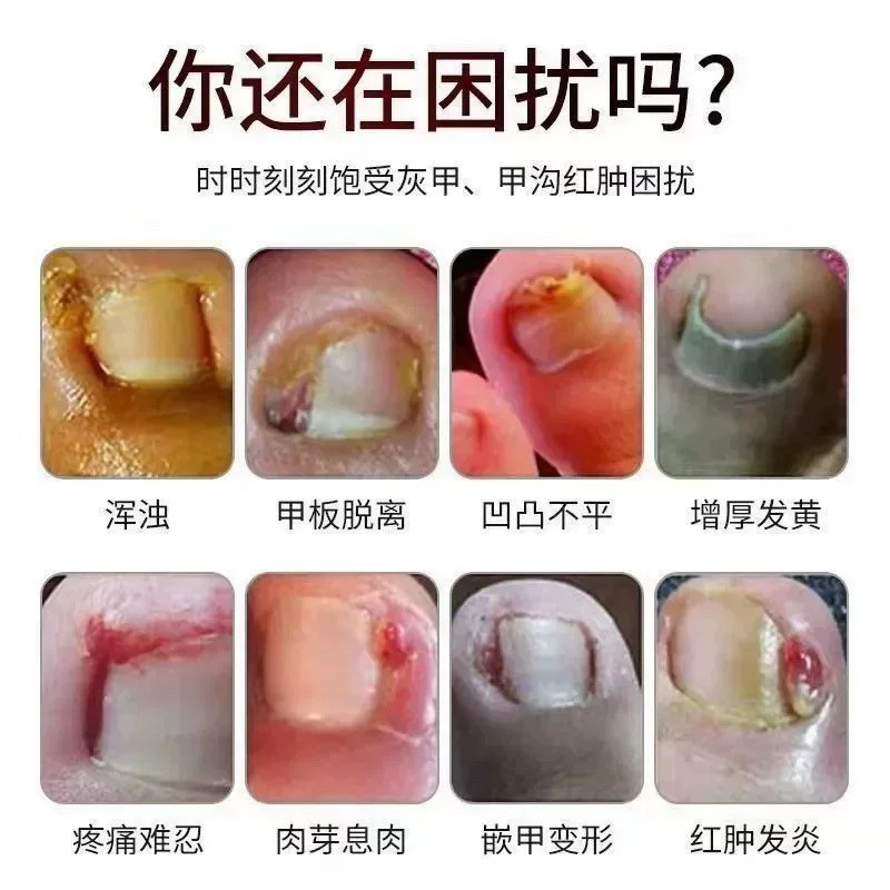 灰甲王真的能治灰指甲?严重甲沟炎也能救!这波不冲亏大了😭-指甲修护乳-淘宝百科网
