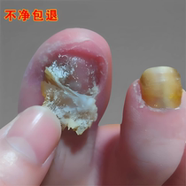 (Watsons best-selling) One drop of it can inhibit bacteria without removing nails and remove 99% of gray potassium fungi. If invalid return guarantee