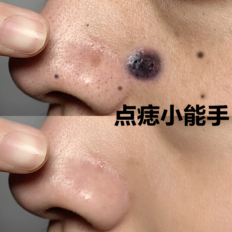(Recommended by Xiaohongshu experts) Go to all kinds of stubborn spots on the face, lighten melanin, available for men and women