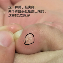 Chicken eye patch wart skin removal hand Tongrentang correction toe spines remove foot Thorn ointment pharmaceutical non-Baiyun Mountain