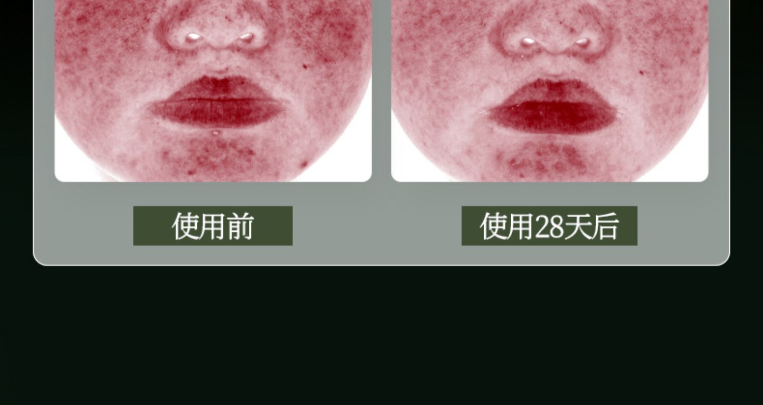 淮树金银花清颜面膜补水保湿控油祛痘淡化痘印平衡水油