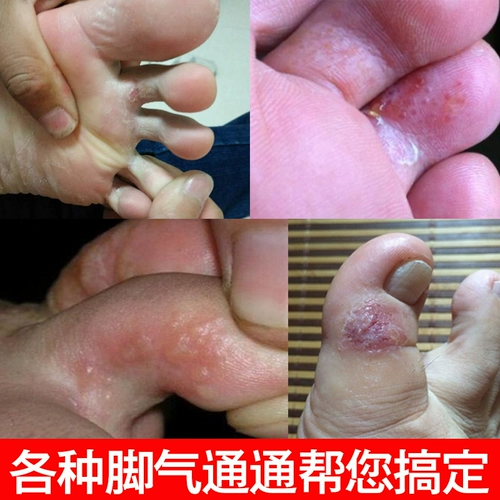 Спортсмен для удаления корневого артефакта, колокольчика, защитывания, анти -килограммы лекарства, гнилой ноги, так что блефовый запах ноги подличная мазь