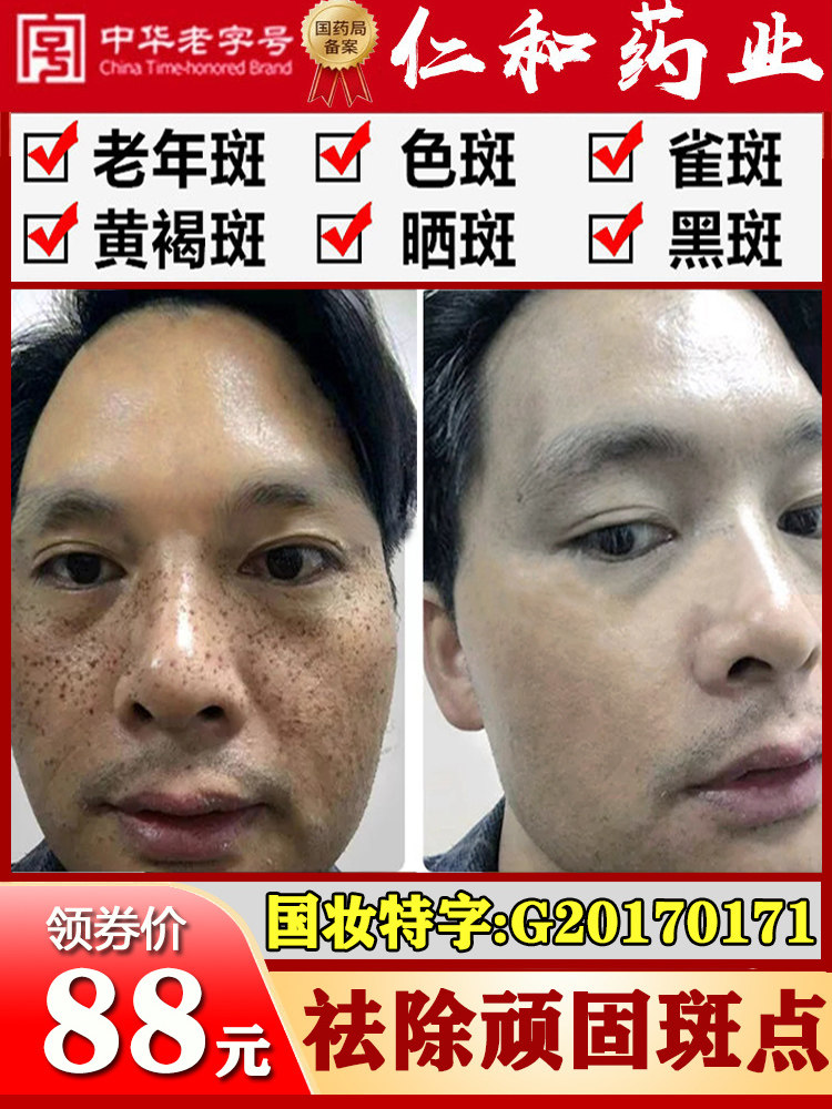 Freckle artifact Men's special freckle cream Whitening dilute pigmentation to remove melasma freckles Old country goods