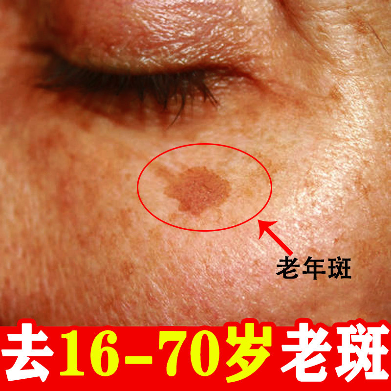 Nanjing Tongren Hall Dispatches Spot Cream Whitening to Senile Spotted Yellow Brown Spotted to Hand Face Flagship Store