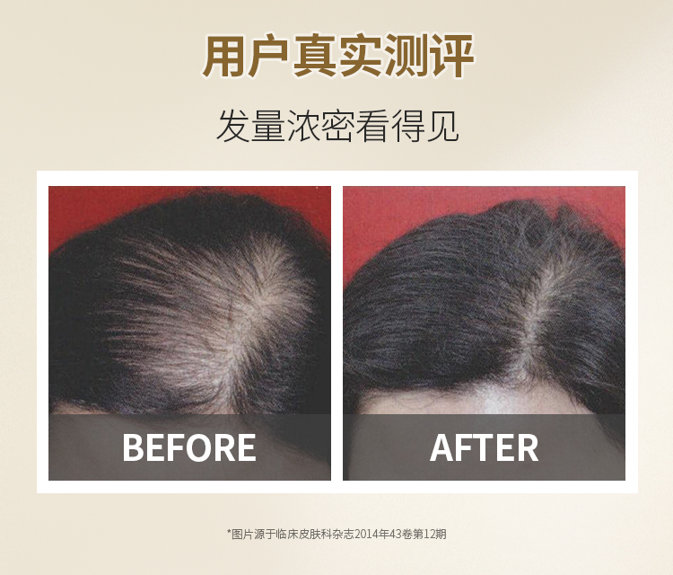 真有效的国药OTC 蔓迪 米诺地尔酊 女性防脱生发喷剂 30ml 图11
