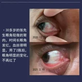Устранение глаза глаз, глазные капли, глаза, глаза, полипы мяса, инородное тело, глаз, сухой зуд, усталость, зелье усталости