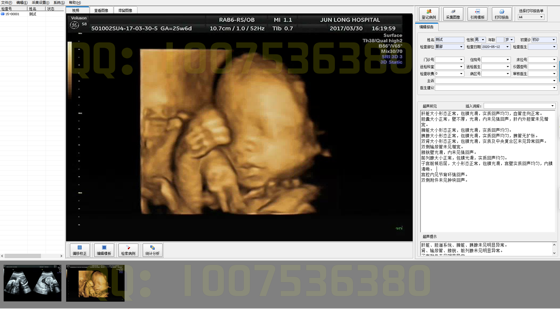 Ultrasound Workstation Color Doppler Software Gastroenteroscopy Hysteroscopy Laparoscopy Otolaryngoscope PACS System CT CR DR Software