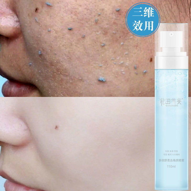 Finish Mousse Spray Die Skin Facial Horniness Men's Face Women Gentle Deep Clean Body Blackhead Mites