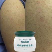 2021 chicken skin pimple hair follicle keratosis removal artifact vitamin a lactic acid cream red dot black dot hair week arm legs