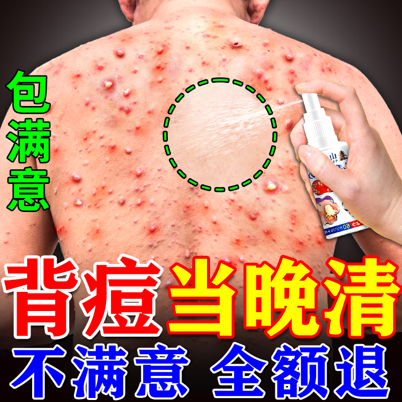 Acne on the Back, Hair Follicle Inflammation, Mite Removal, Acne Itching Relief, Arm Pimples, Malassezia Bacteria Effective Medicine, Special Spray