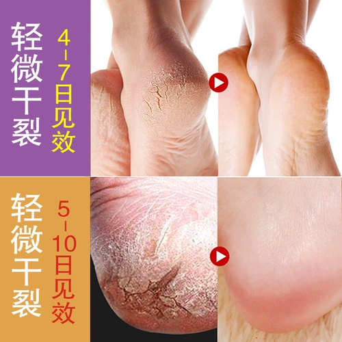 Xiaohongshu Hot -Showerseclosion ~ ног стопы ~ сегодняшняя специальная цена ~ купи один, получи один бесплатный