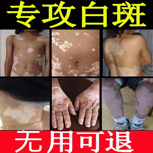 Внешнее лекарство вититилиго белые пятна чистые рецепты рецепта рецепта пинетика и мазь Мази раствор места для пота специальное лекарство Япония
