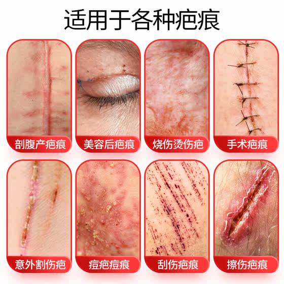 Bodi medical silicone gel double eyelid surgery caesarean section scar burn scar repair cream light scar special MK