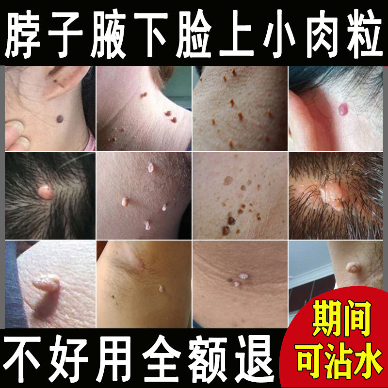 扁平疣面部去除膏真的能一抹灵治好吗?它适合所有类型的疣吗?-针灸器具器械-淘宝好物网