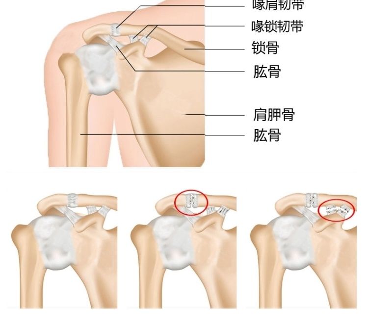 Dây đeo vai thể thao Thể dục bóng rổ Dụng cụ bảo hộ thể thao Nam và nữ Dụng cụ bảo vệ vai Bảo vệ cánh tay - Dụng cụ thể thao