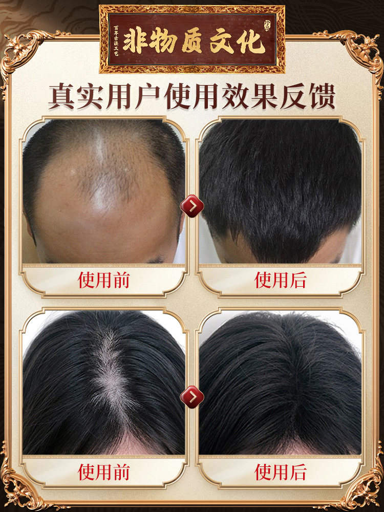 Platycladus Orientalis Leaf Chinese Herbal Shampoo Prevents Hair Loss, Stimulates Hair Growth, and Increases Hair Density. Official Flagship Store Ranked First