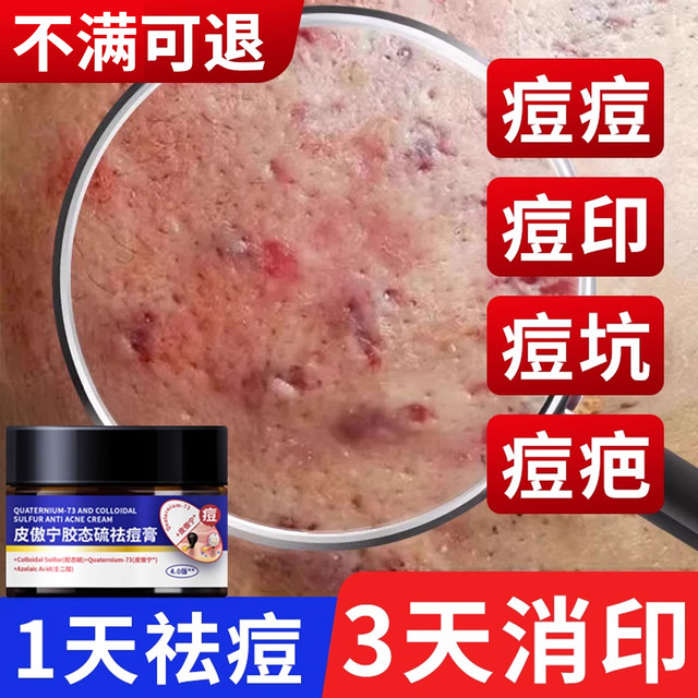 Anti-Acne Cream Official Flagship Store Genuine Anti-Acne and Lightening Acne Pits and Acne Marks Acne Azelaic Acid Anti-Acne Gel