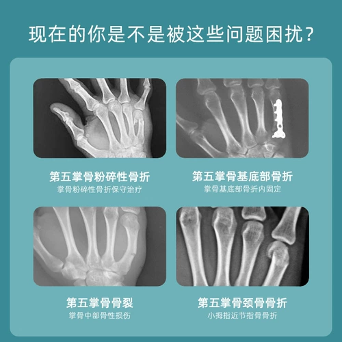 Перелом перелома запястья уход за запястьем фиксация ветви Пятая пальмовая кость