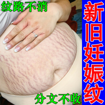 Remove stretch marks obesity mark repair cream fade growth marks preventive postpartum repair cream for pregnant women tighten skin