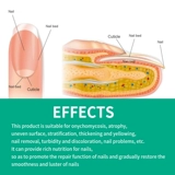 Грибные грибки Attments Serum Cream против грибковых ног ногте