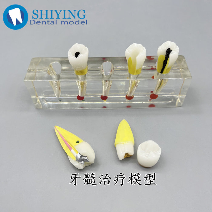 牙科牙髓模型解剖前磨牙龋坏牙冠髓腔充填可拆牙陈列展示练习模型