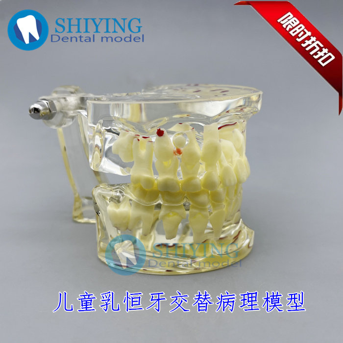 牙科 儿童病理模型 牙齿龋坏 乳牙恒牙交替更换牙粒模型 4002包邮