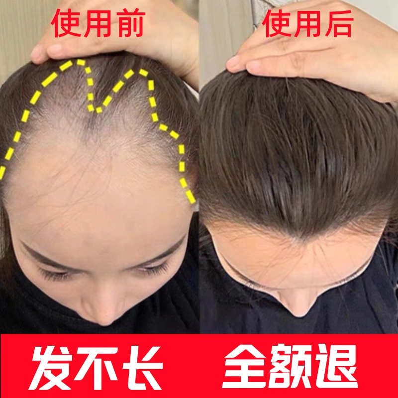 (short I eat) hair natural growing speed Men and women hair Speed Thinning Hair Lotion Shampoo-Taobao