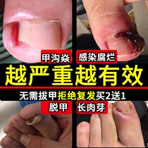 Meadusitis special ointment Soft A detumescence Go to meat Sprout Toe Nails to the meat Rigree Bundesliga straightener